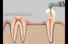 Embedded thumbnail for  Протезирование зубов мостовидное